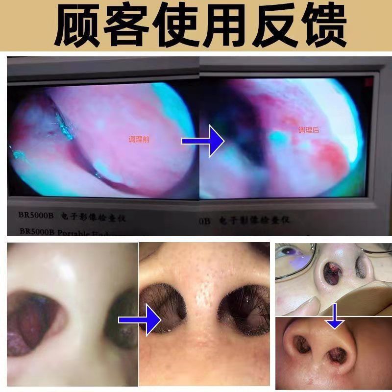 88794-【100%除裉】鼻窦炎鼻塞通鼻神器特效喷雾鼻息肉鼻甲肥大鼻炎喷剂-详情图