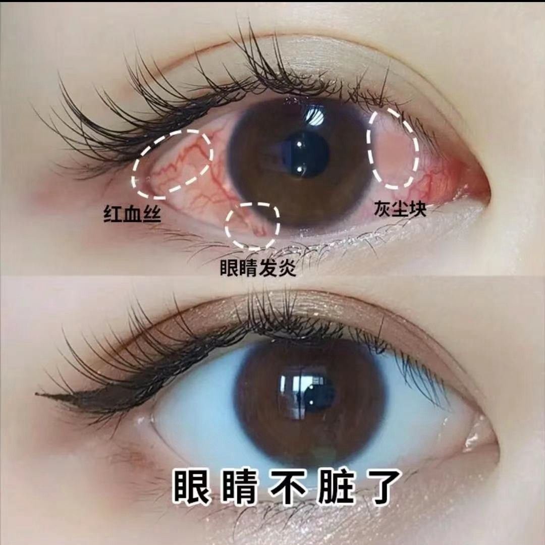 【最快一天】红血丝眼睛充血眼睛痛迎风流泪抗疲劳眼睛干涩眼药水