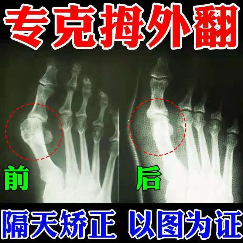 75618-成功率99%】拇外翻神器男女士大脚骨足外翻矫正器脚趾重贴专用贴-详情图