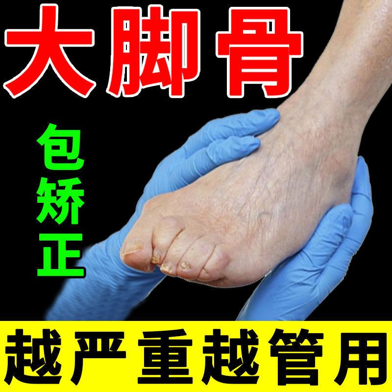 75618-成功率99%】拇外翻神器男女士大脚骨足外翻矫正器脚趾重贴专用贴-详情图