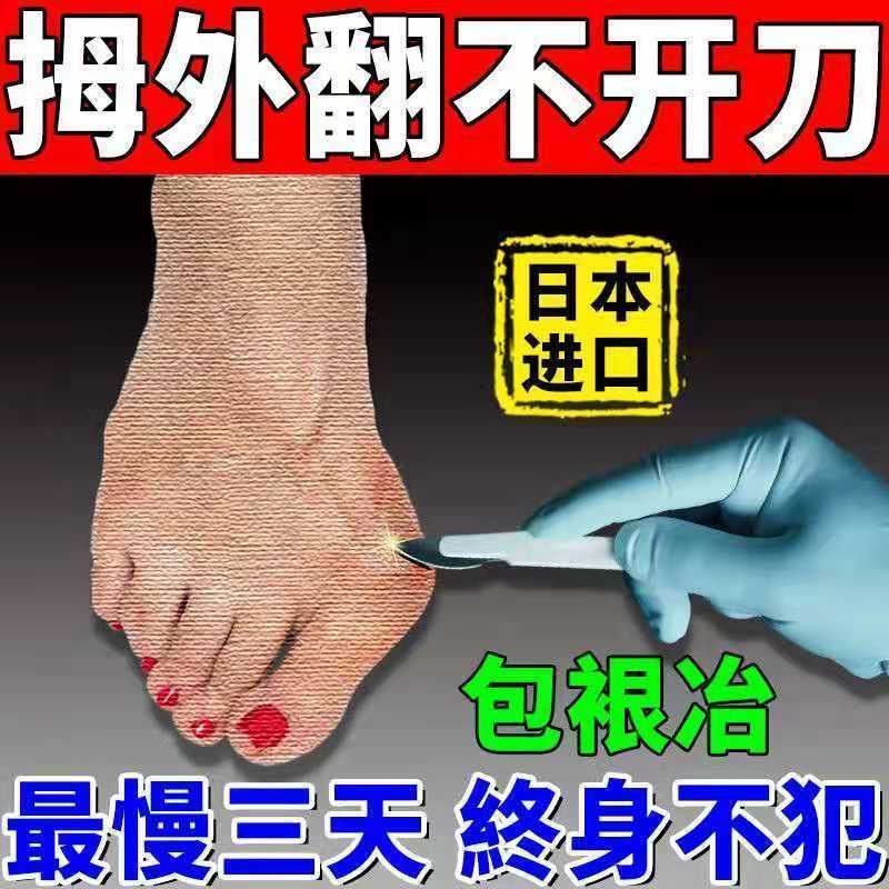 75618-成功率99%】拇外翻神器男女士大脚骨足外翻矫正器脚趾重贴专用贴-详情图