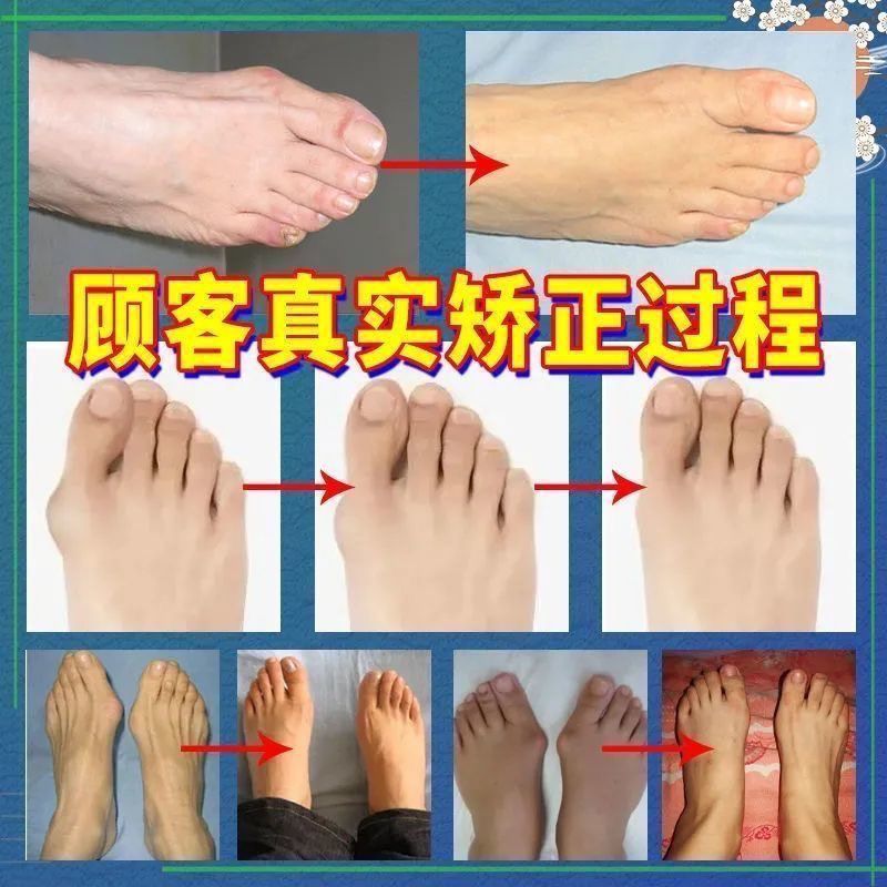 75618-成功率99%】拇外翻神器男女士大脚骨足外翻矫正器脚趾重贴专用贴-详情图