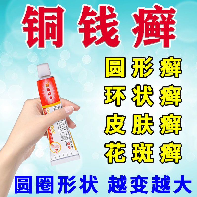 铜钱癣圆形环状皮肤癣花斑癣头皮癣股癣手足癣脱屑金达克宁乳膏h