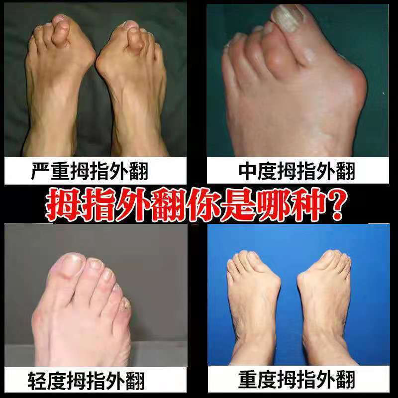75618-成功率99%】拇外翻神器男女士大脚骨足外翻矫正器脚趾重贴专用贴-详情图