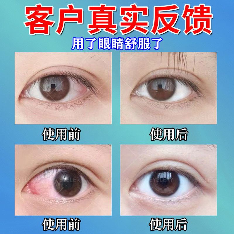 眼睛痒眼药水过敏发痒眼角痒干涩发痒视力模糊常流眼泪止痒滴眼液 虎窝拼