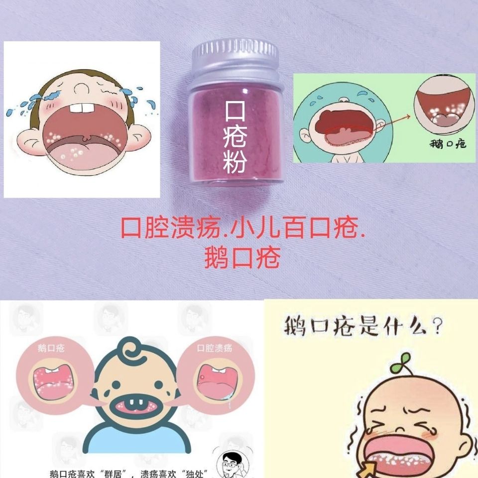 【口腔溃疡】鹅口疮小儿百口疮口腔感染嘴角溃烂舌头起泡牙龈肿