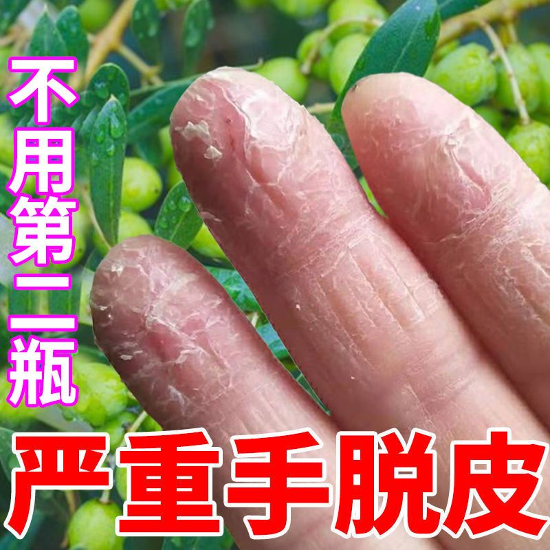 手脱皮真菌感染脱皮膏季节性手脱皮手足脱皮手脚脱皮膏痒膏鹅掌风