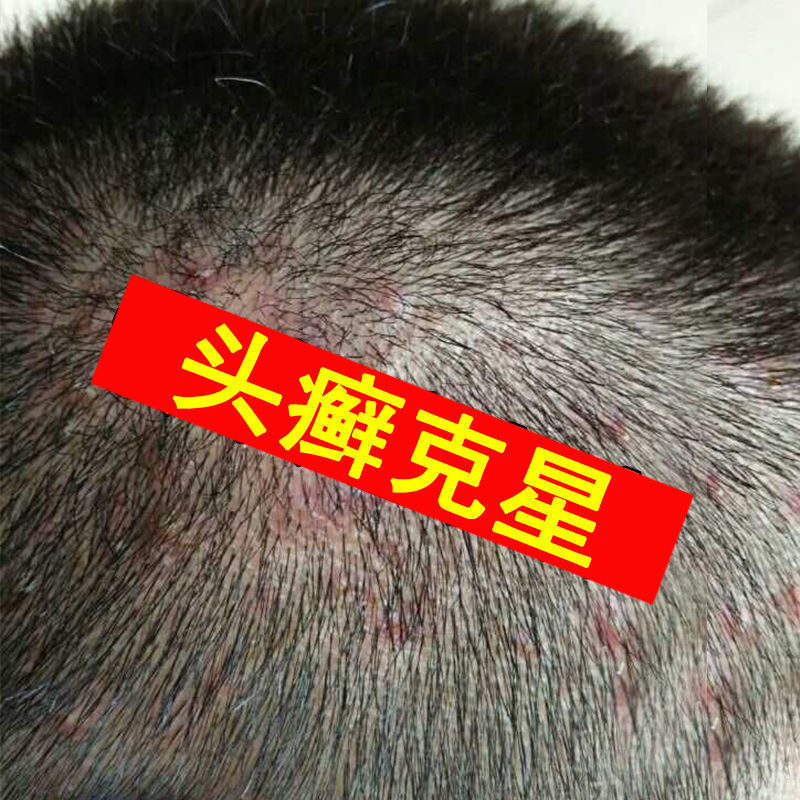 【头藓专用】头皮癣银屑头皮红疹皮肤瘙痒毛囊炎真菌感染抑菌膏