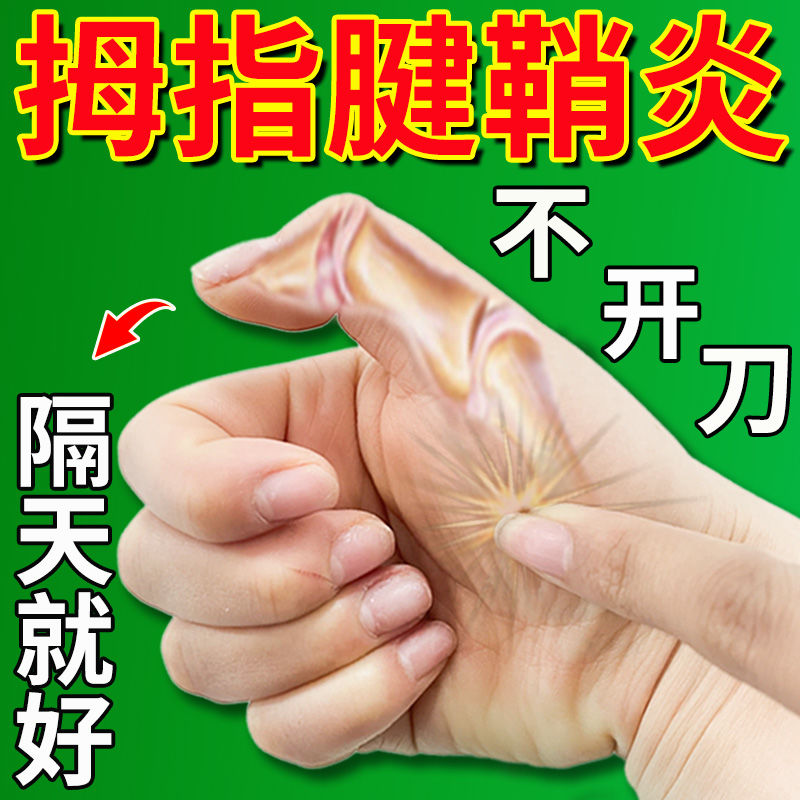 大拇指腱鞘炎【不用开刀】手指关节疼痛麻木屈伸困难手腕囊肿鼓包