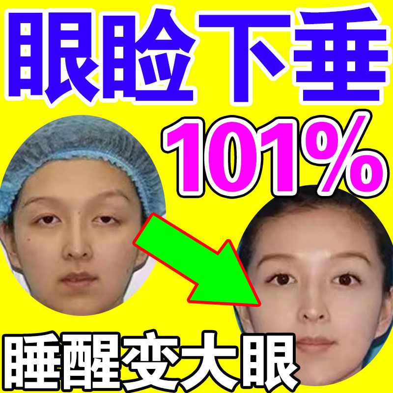 上睑下垂【眼皮下垂】眼皮松弛下垂提拉眼皮眼皮肿紧致眼皮下垂