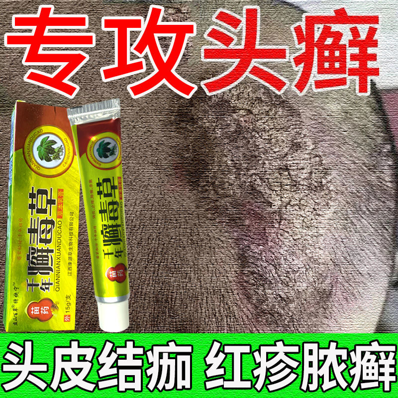 头癣头皮癣【不好用可退】牛皮癣头皮脂溢性皮炎头皮银屑毛囊炎