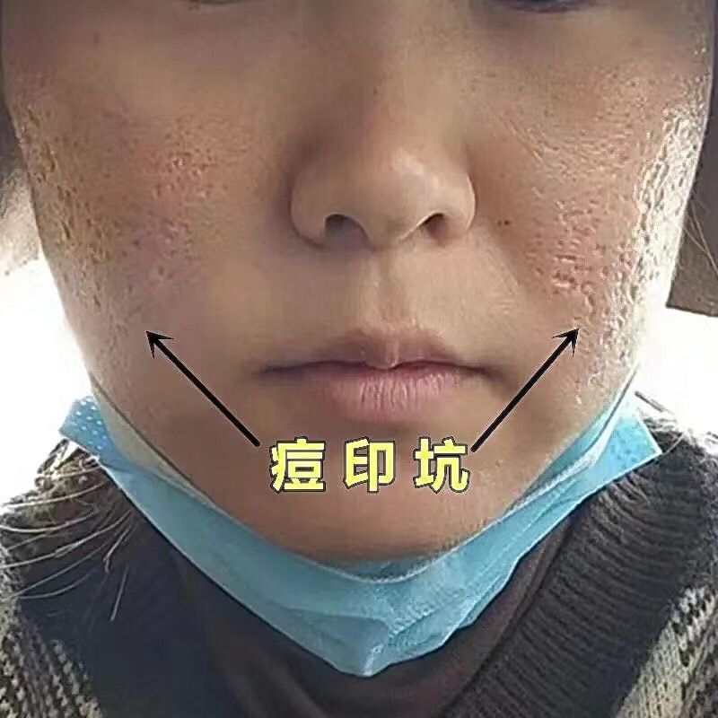 【去印不留痕】去痘印去痘坑痘疤祛痘膏黑色凹洞素修复毛孔抗痘膏