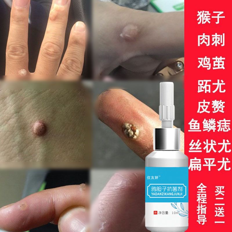 去脚底死皮治鸡眼跖疣寻常疣瘊子去刺猴子肉刺鸡眼膏疣拓疣去疣