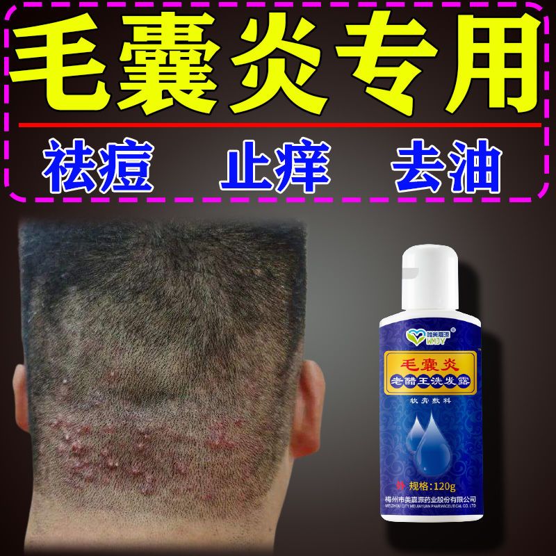 毛囊炎洗发水祛痘控油去屑止痒头癣脓包痘痘硬疙瘩斑秃除螨抑菌