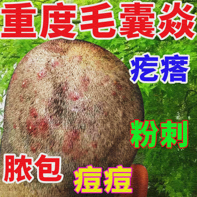 攻头皮毛囊焱乳膏头部胸背部螨虫痘痘脓疮包痤疮疙瘩毛囊焱抑菌膏