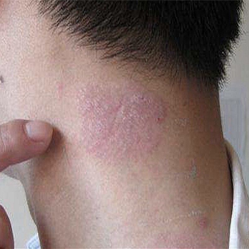 皮肤止痒抑菌乳膏过敏性大腿内侧瘙痒牛皮癣皮焱湿疹荨麻疹止痒膏 虎窝拼