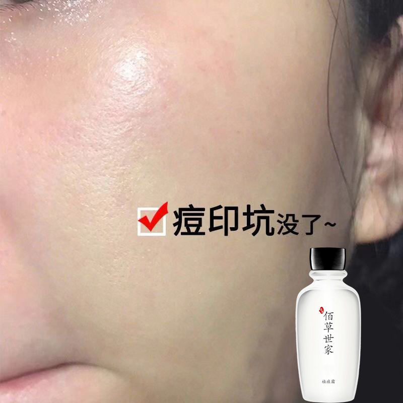 祛痘坑痘印痘疤凹洞修復填充再生淡化痘印去痘印黑色素