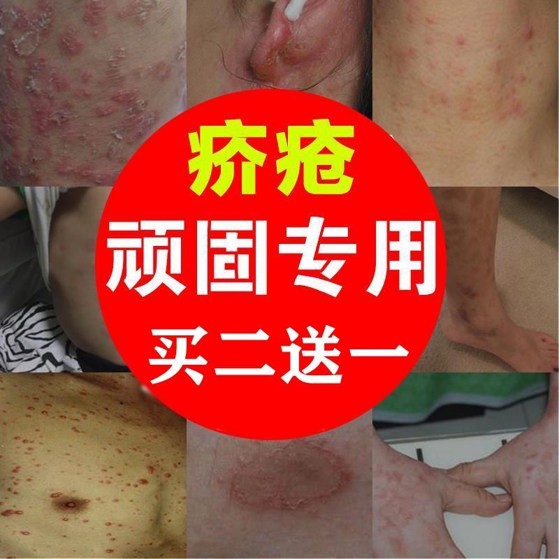 疥疮膏特效疥苍结节疥虫阴虱去螨虫大腿内侧皮肤瘙痒止痒硫磺软膏