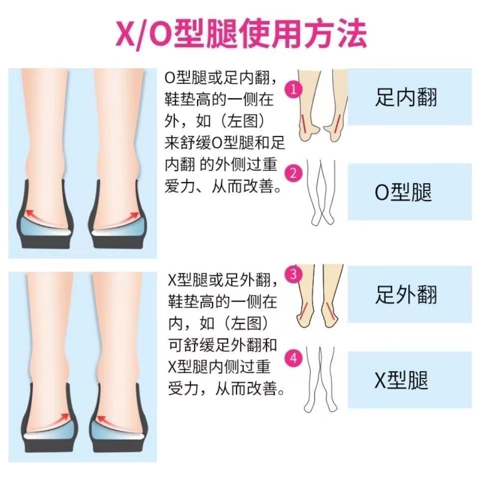 矫正腿型ox型腿部永久直腿鞋垫瘦内八小腿外翻腿足外翻腿型矫正器