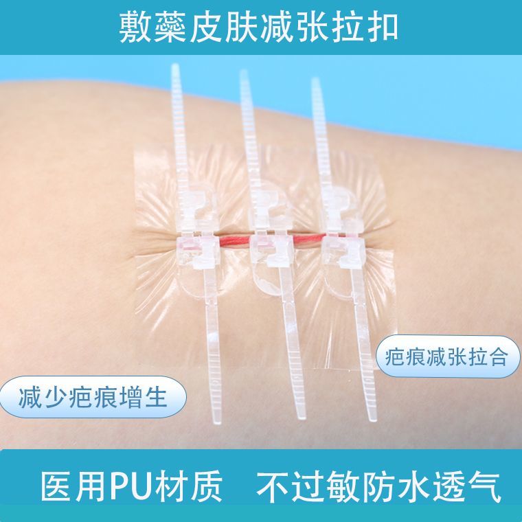 医用减张器疤痕减张拉扣弹性绑带拉扣拉合器拉链式减张贴敷料固定