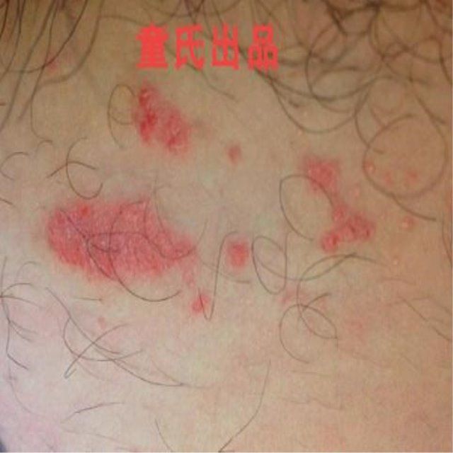 屁股上长疙瘩肛门瘙痒屁眼痒男性百邦广盛元 宫廷癣痒膏皮肤外用